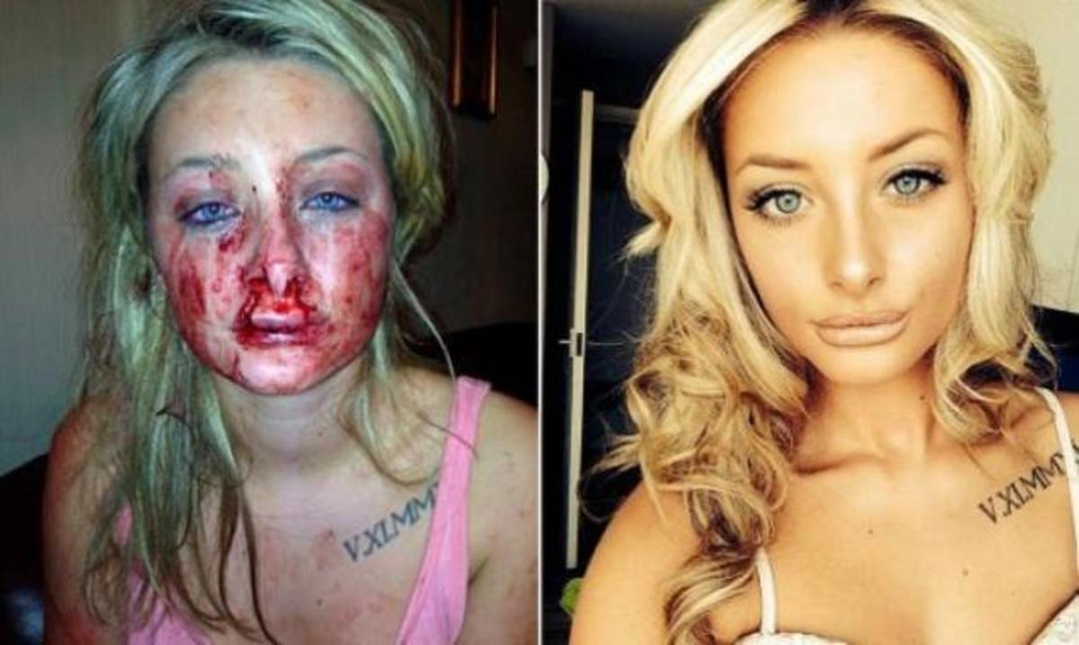 Ο Χάνιμπαλ Λέκτερ της Βρετανίας – Τη δάγκωσε στο πρόσωπο επειδή ζήλευε