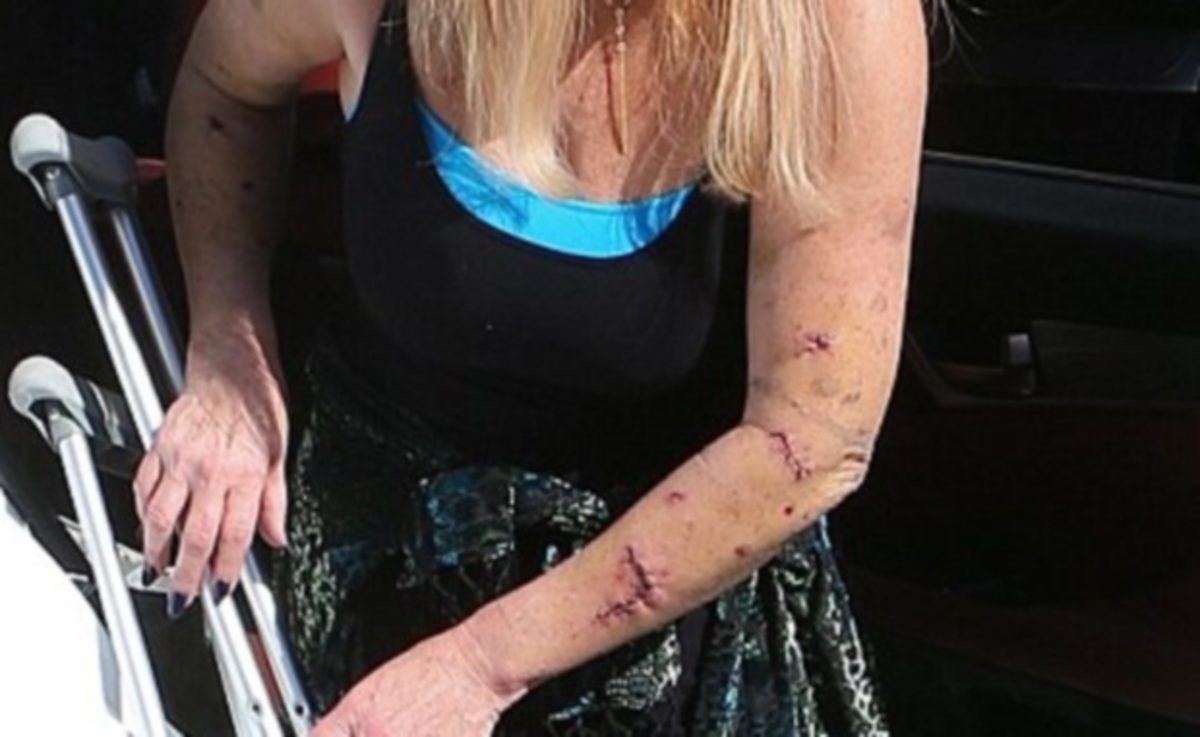 Ανατριχιάζουν οι φωτογραφίες της ηθοποιού που δέχτηκε επίθεση από σκύλους