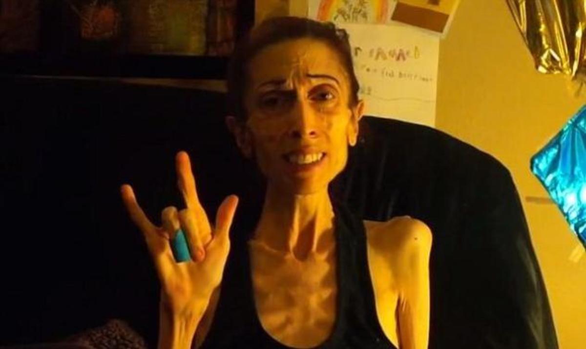 Rachael Farrokh: Συγκλονίζει η 37χρονη ηθοποιός που πεθαίνει από ανορεξία