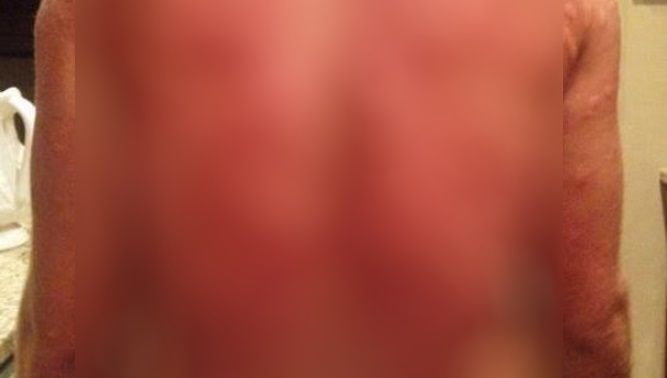 Δέχτηκε ομαδική επίθεση από κουνούπια! Ανατριχιαστική φωτογραφία!