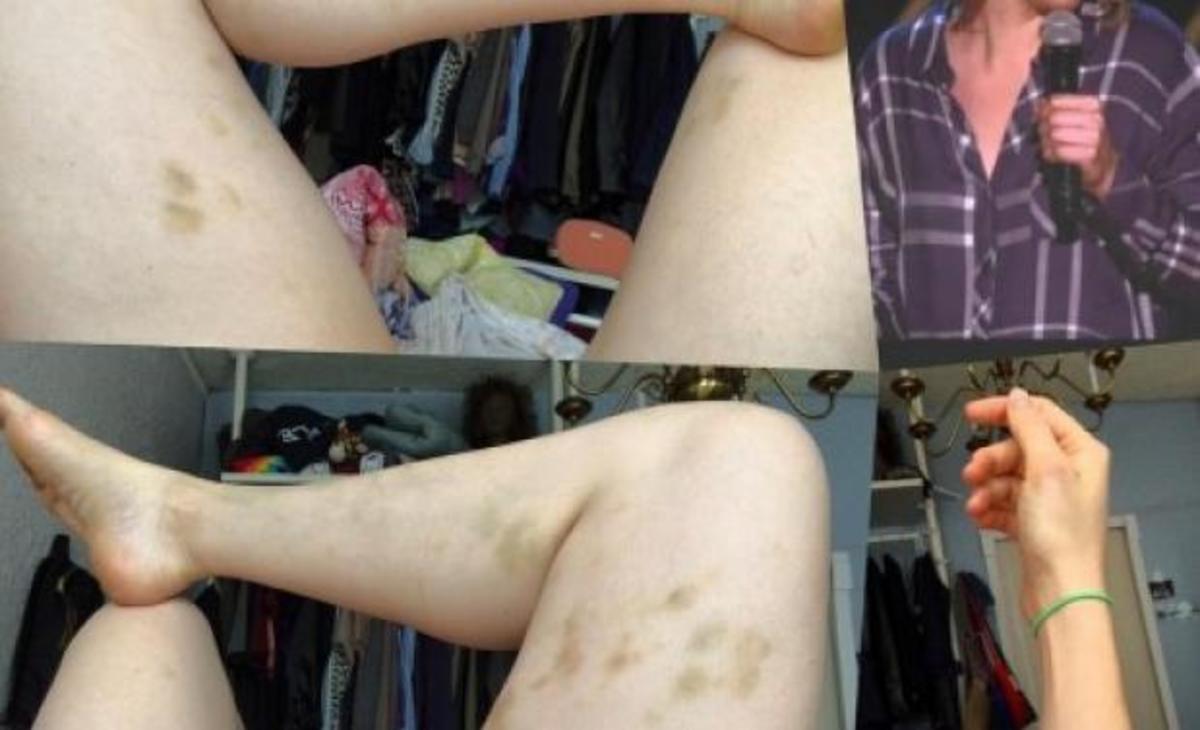 Σοκαριστική φωτογραφία ηθοποιού – Την έδερνε και τη βίασε ο φίλος της