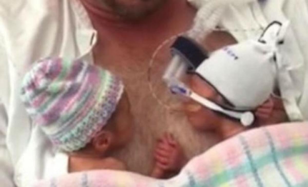 Το βίντεο με τα πρόωρα δίδυμα που έχει λυγίσει το ίντερνετ