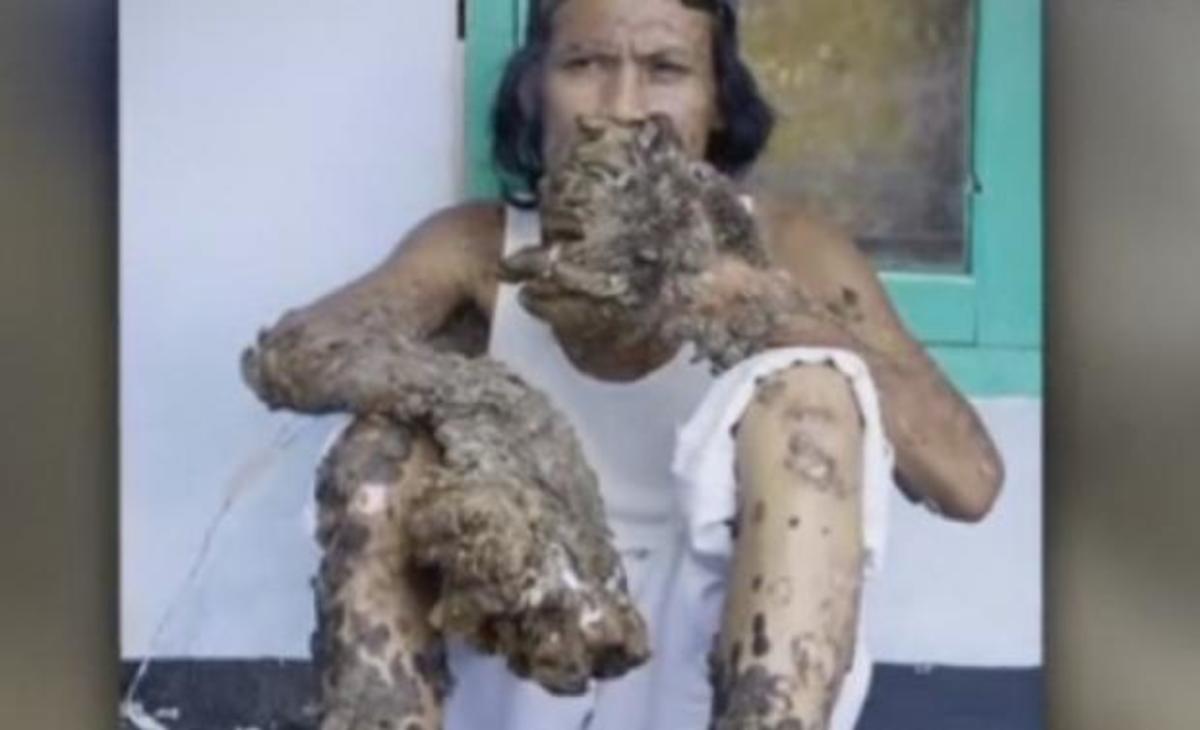 Πέθανε ο “άνθρωπος – δέντρο”, νικημένος από τον ιό “Λεβαντόφσκι” (ΒΙΝΤΕΟ & ΦΩΤΟ)