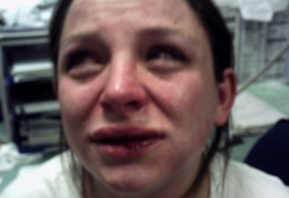 Σοκαριστικό! Σύζυγος παίκτριας ριάλιτι της έσπασε το σαγόνι μετά τη γέννηση των διδύμων τους