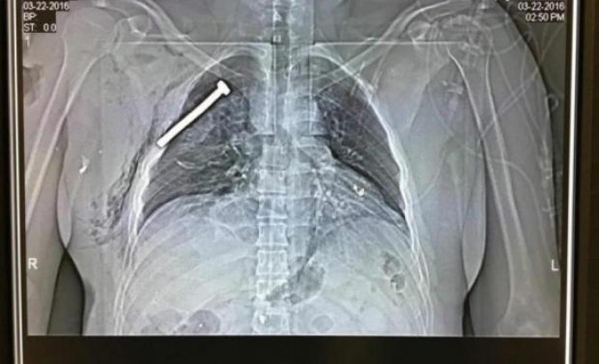 Βρυξέλλες: Συγκλονιστικό! Βίδα καρφωμένη στο κορμί τραυματία του μακελειού! (ΦΩΤΟ)