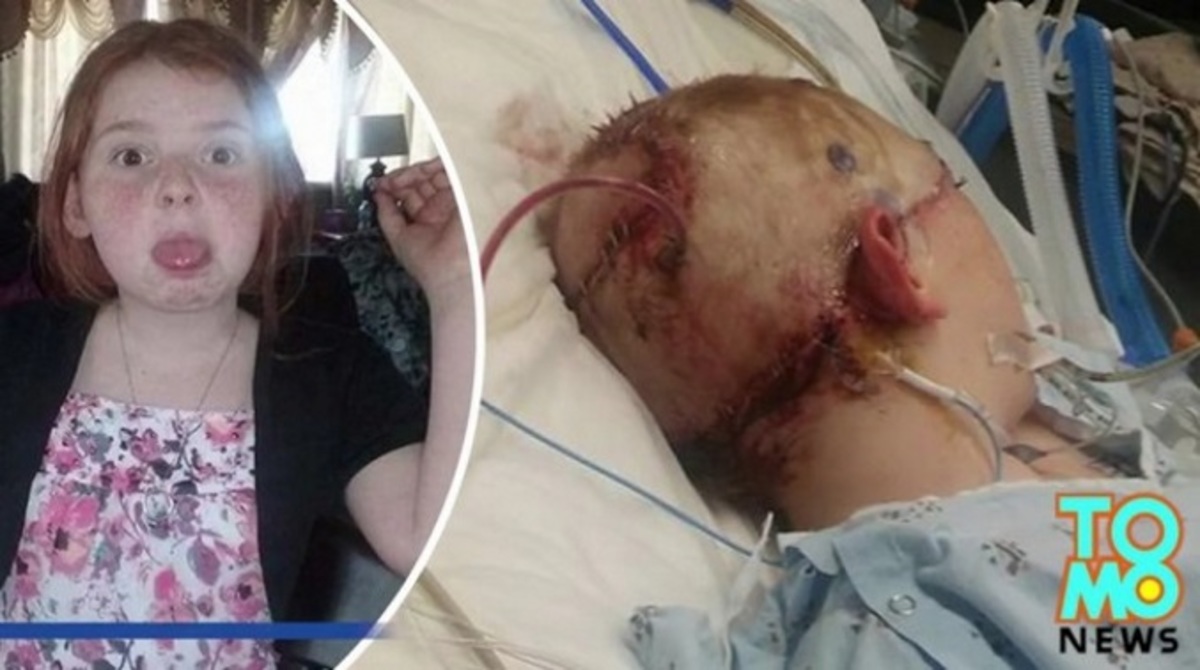 Ξεριζώθηκε το scalp 11χρονης όταν πιάστηκαν τα μαλλιά της σε τρενάκι λούνα παρκ!