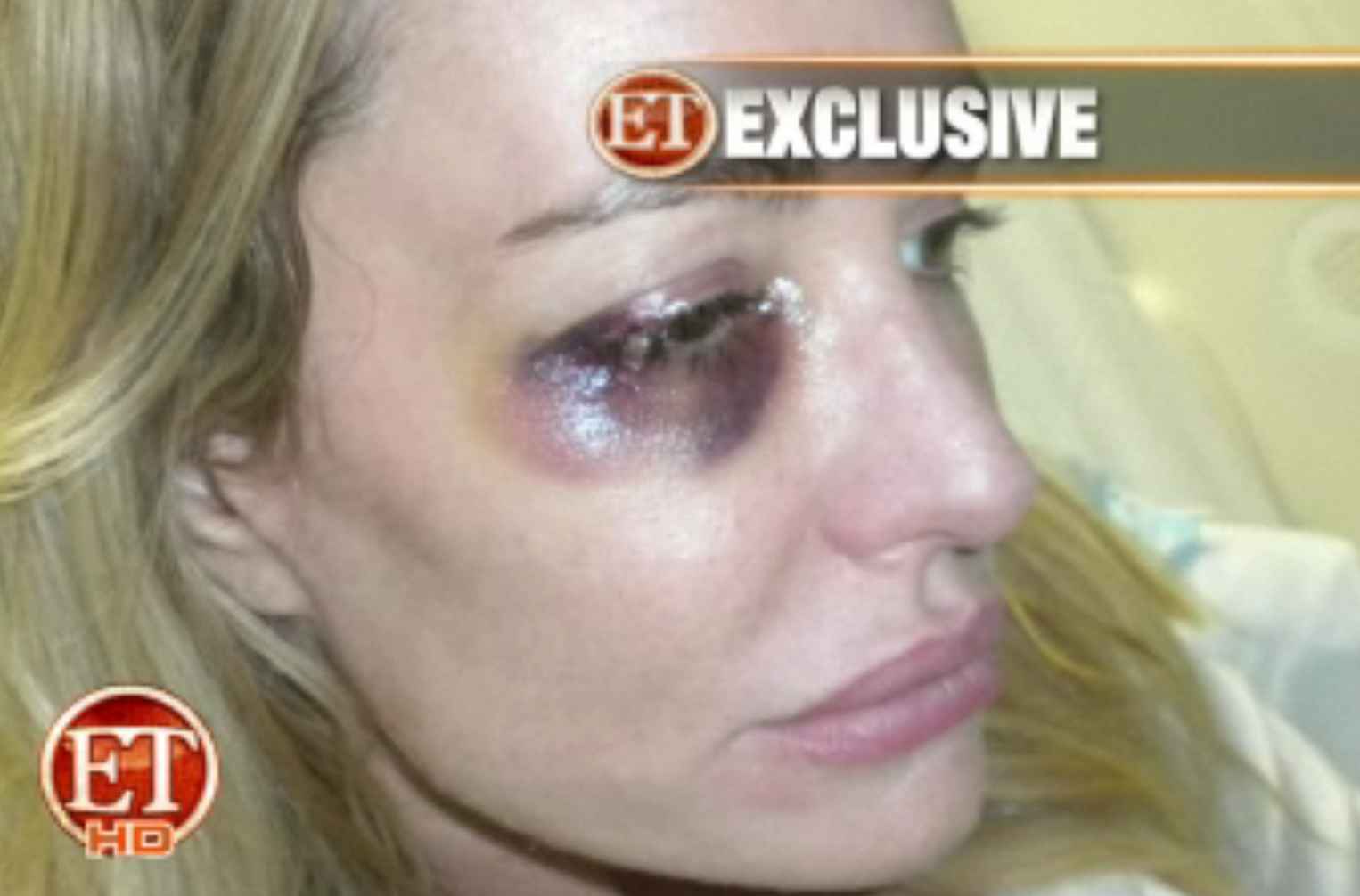 Οι σοκαριστικές φωτογραφίες της “Real Housewife” Taylor Armstrong