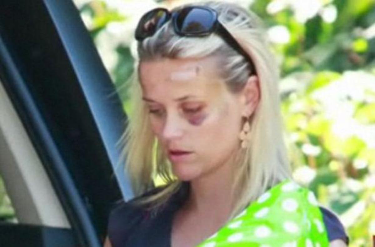 Οι πρώτες φωτός της Reese Withersroon μετά το ατύχημα της