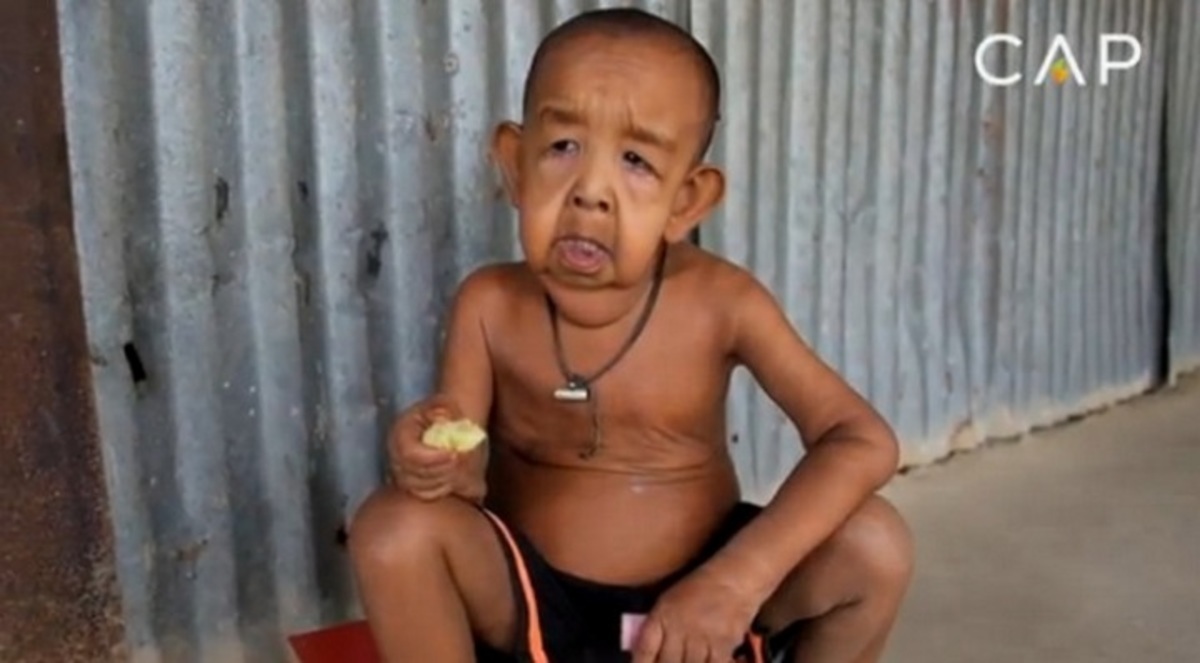 Η συγκλονιστική ιστορία του 4χρονου που μοιάζει 80χρονος (vid)